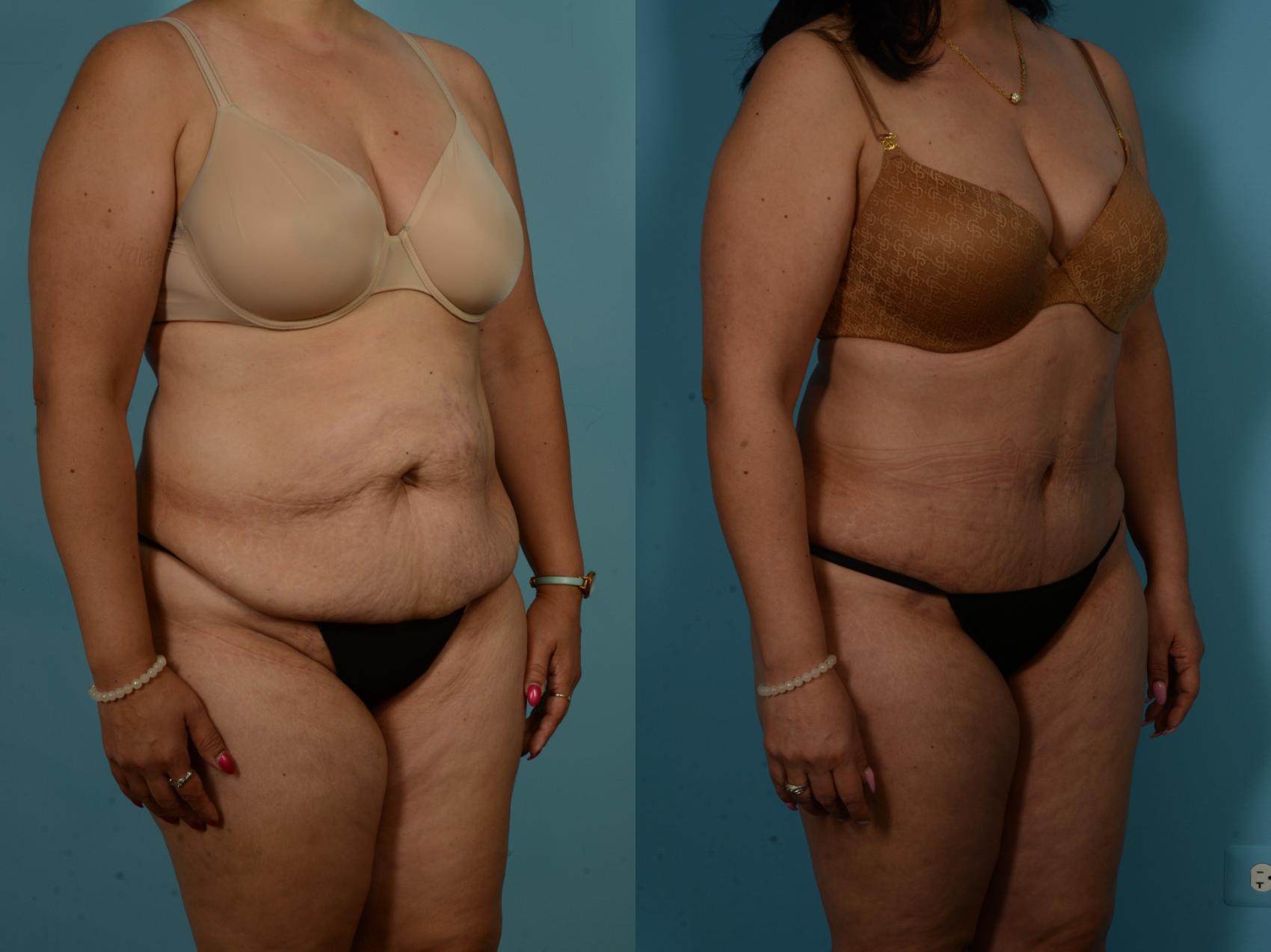 Before & After Tummy Tuck by Dr. Sinno Case 1019 Right Oblique View in Chicago, IL