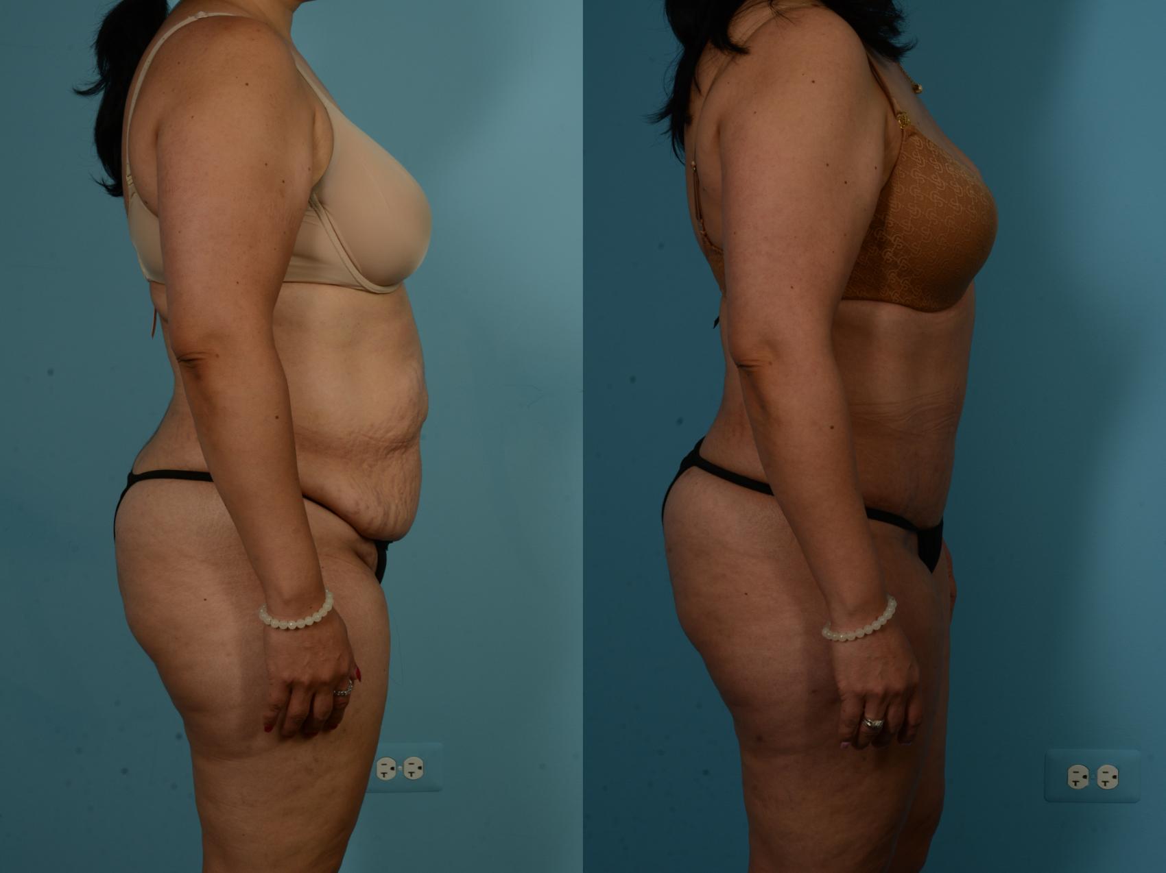 Before & After Tummy Tuck by Dr. Sinno Case 1019 Right Side View in Chicago, IL