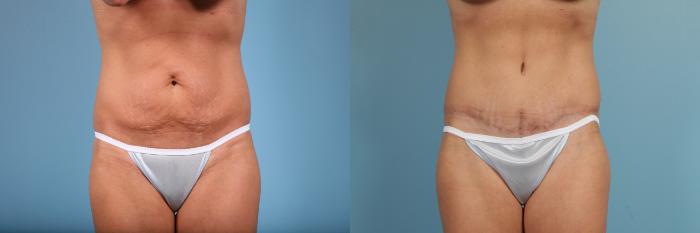 Before & After Tummy Tuck Case 103 View #1 View in Chicago, IL