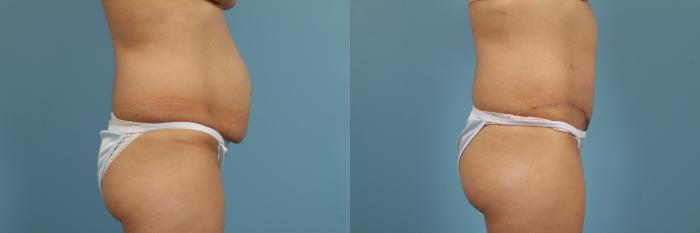 Before & After Tummy Tuck Case 148 View #3 View in Chicago, IL