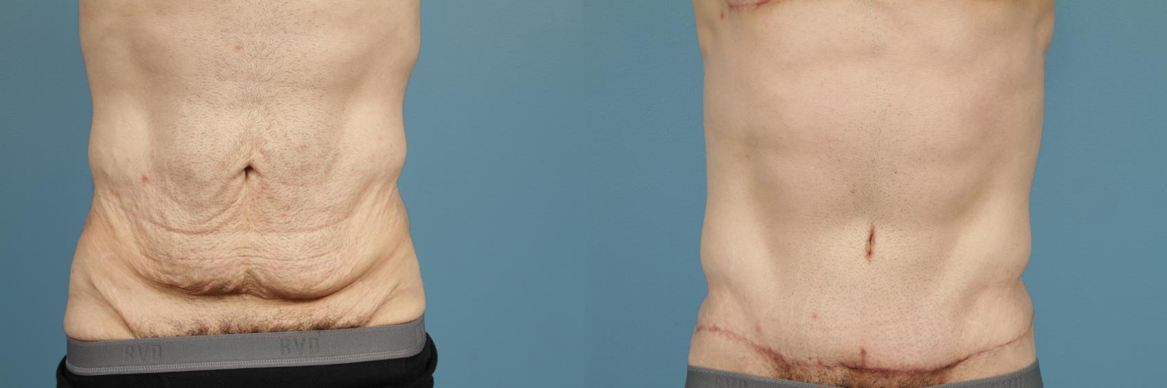 Before & After Tummy Tuck Case 166 View #1 View in Chicago, IL