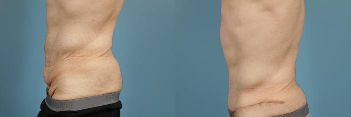 Before & After Tummy Tuck Case 166 View #2 View in Chicago, IL