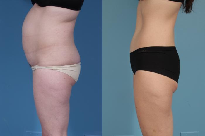 Before & After Tummy Tuck Case 176 View #2 View in Chicago, IL