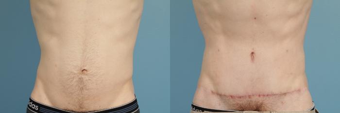 Before & After Tummy Tuck Case 181 View #1 View in Chicago, IL