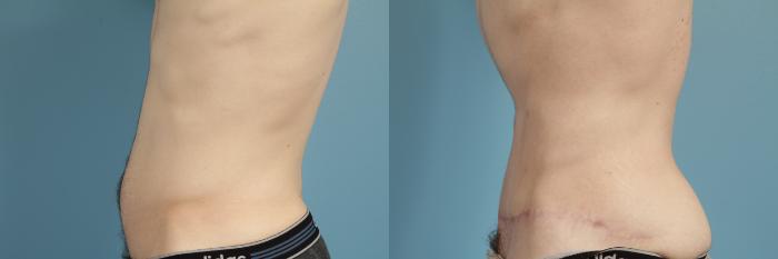 Before & After Tummy Tuck Case 181 View #2 View in Chicago, IL