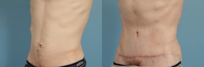 Before & After Tummy Tuck Case 181 View #3 View in Chicago, IL