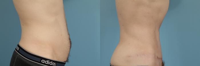 Before & After Tummy Tuck Case 181 View #4 View in Chicago, IL