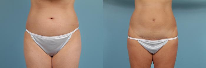 Before & After Tummy Tuck Case 192 View #1 View in Chicago, IL