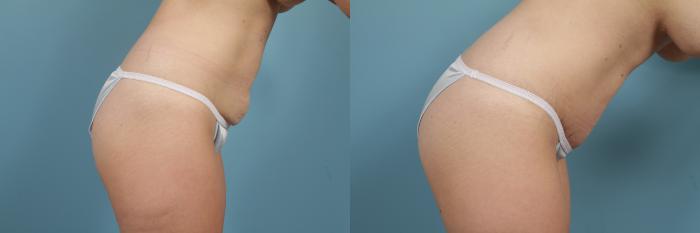 Before & After Tummy Tuck Case 205 View #4 View in Chicago, IL