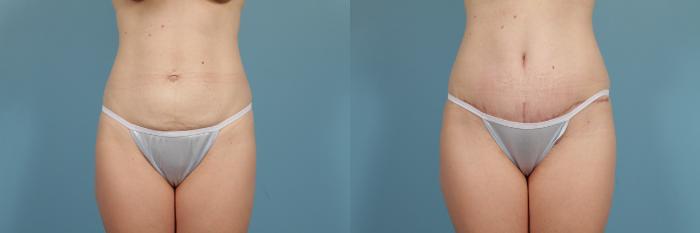 Before & After Tummy Tuck Case 205 View #5 View in Chicago, IL