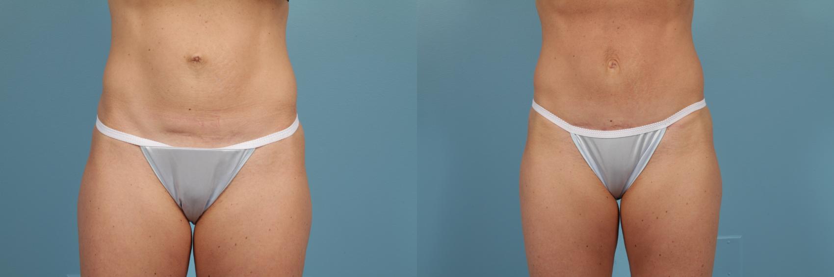 Before & After Tummy Tuck Case 212 View #1 View in Chicago, IL