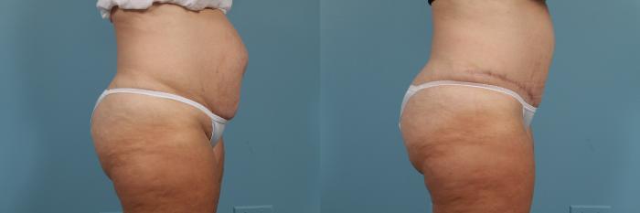 Before & After Tummy Tuck Case 213 View #3 View in Chicago, IL