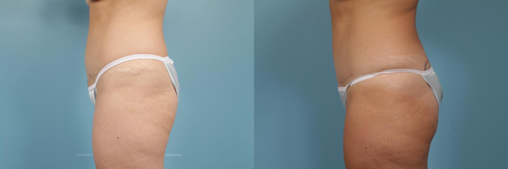 Before & After Tummy Tuck Case 251 View #2 View in Chicago, IL
