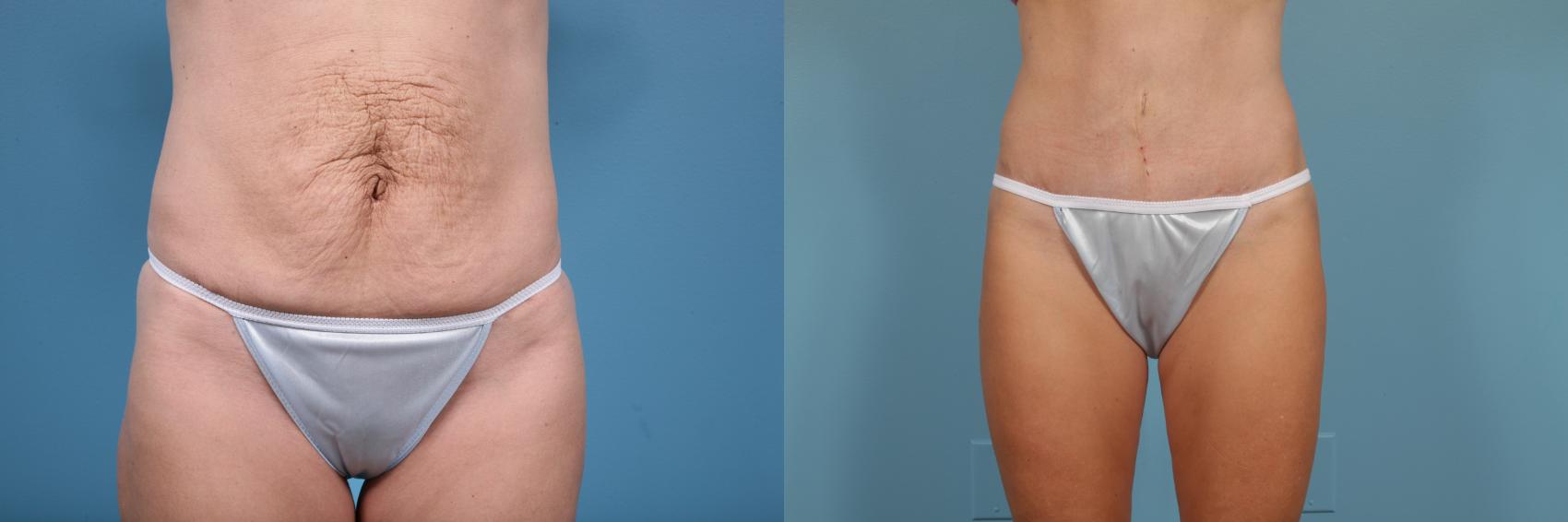 Before & After Tummy Tuck Case 261 View #1 View in Chicago, IL