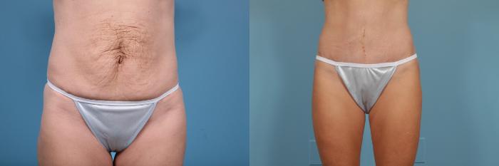 Before & After Tummy Tuck Case 261 View #1 View in Chicago, IL
