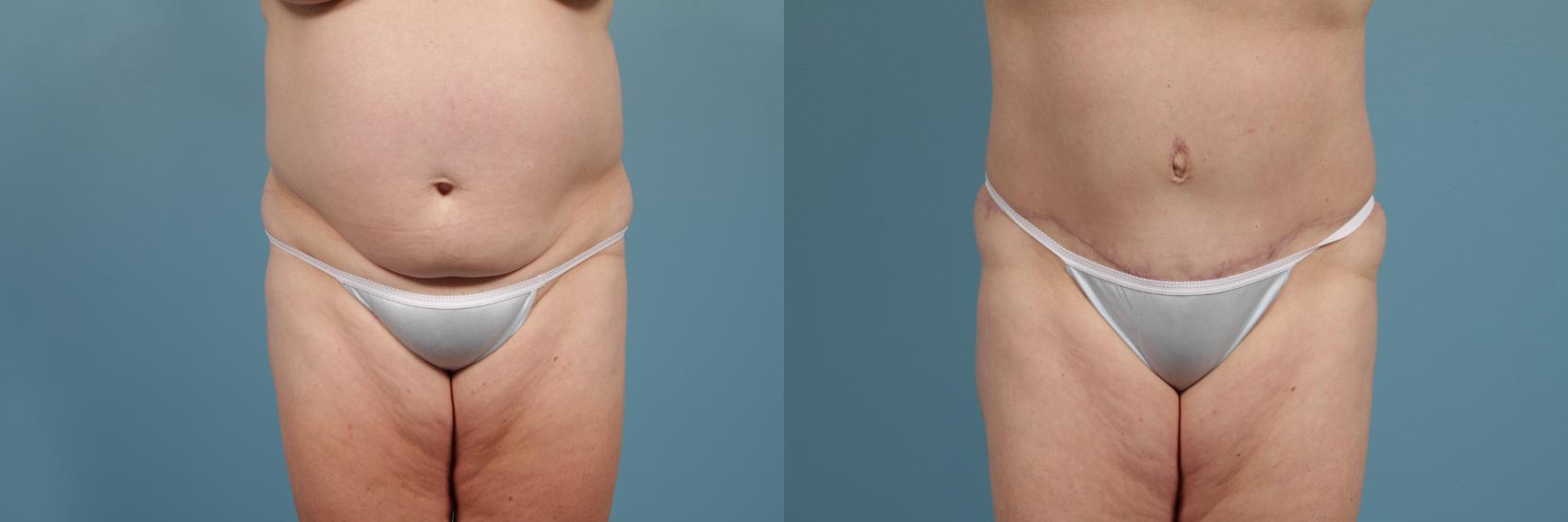 Before & After Tummy Tuck Case 272 View #1 View in Chicago, IL