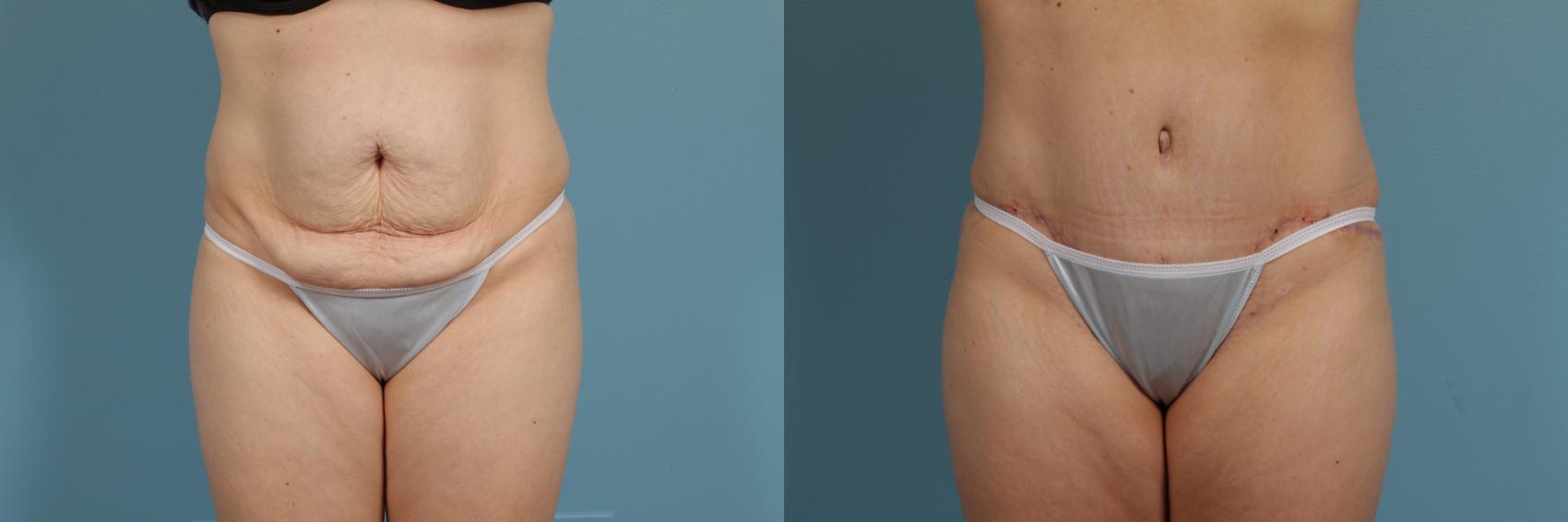 Before & After Tummy Tuck Case 283 View #2 View in Chicago, IL
