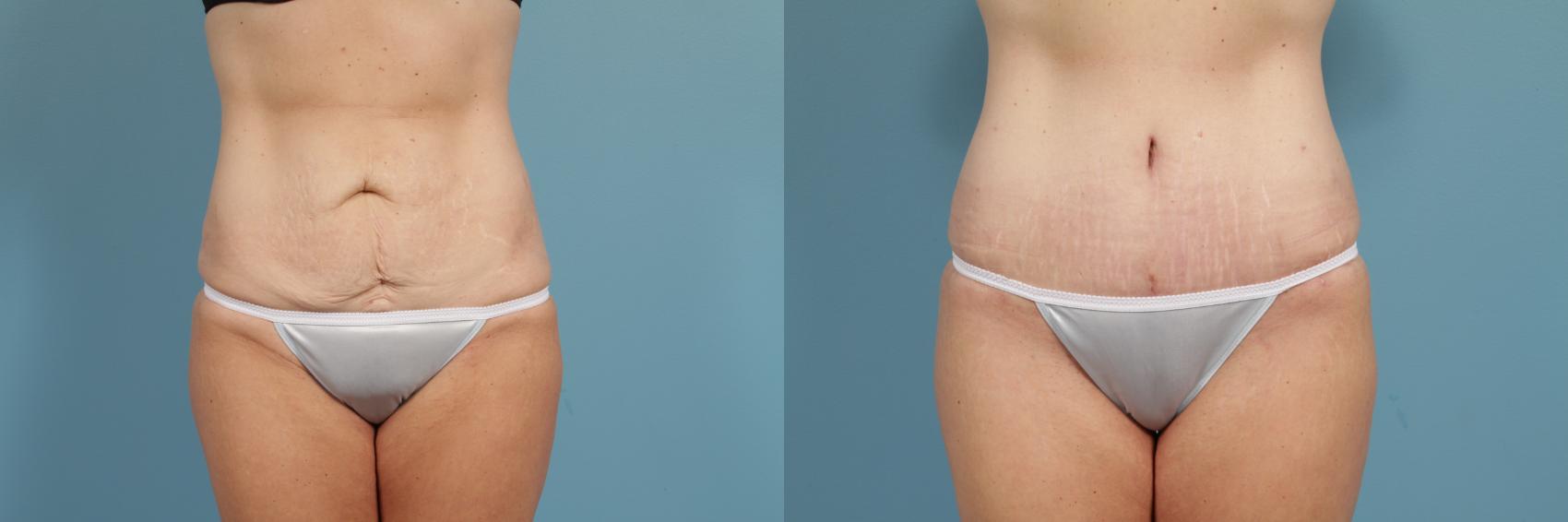Before & After Tummy Tuck Case 293 View #1 View in Chicago, IL