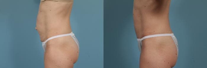 Before & After Tummy Tuck Case 294 View #2 View in Chicago, IL