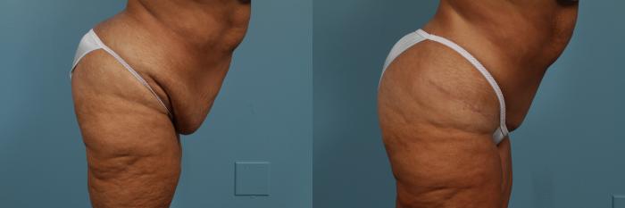 Before & After Tummy Tuck Case 297 View #4 View in Chicago, IL