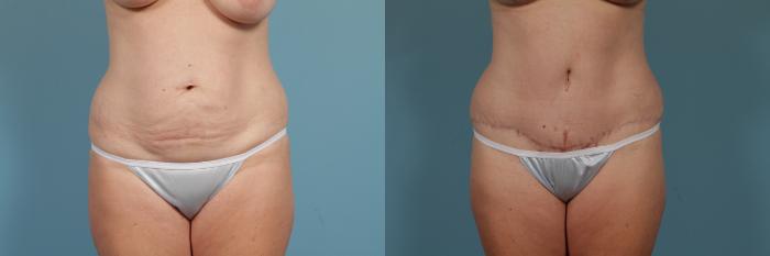 Before & After Tummy Tuck Case 310 View #1 View in Chicago, IL