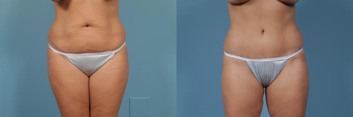 Before & After Tummy Tuck Case 364 View #2 View in Chicago, IL