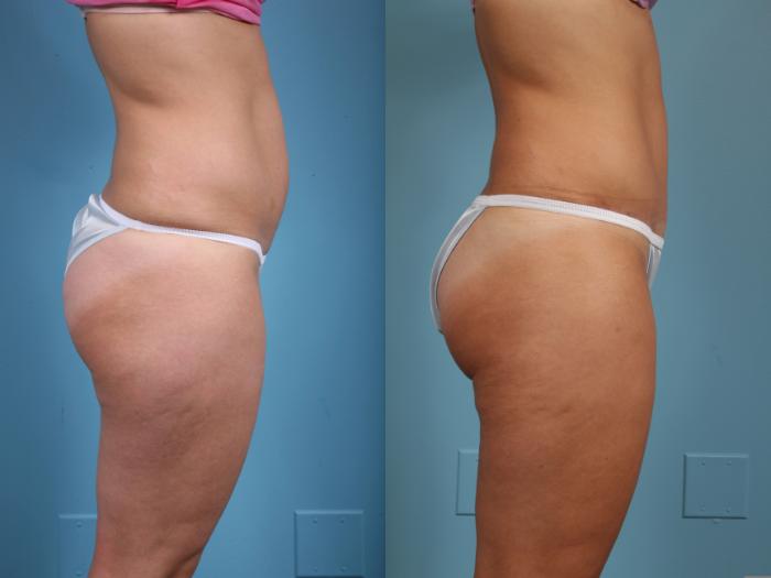 Before & After Tummy Tuck Case 39 View #3 View in Chicago, IL
