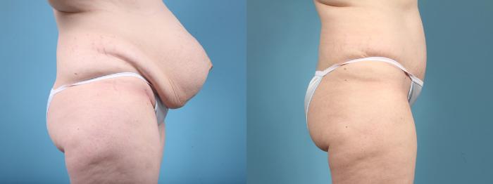 Before & After Tummy Tuck Case 4 View #3 View in Chicago, IL