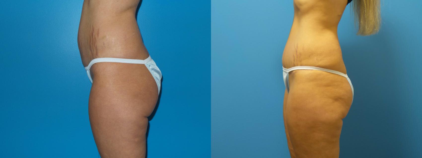 Before & After Tummy Tuck Case 421 View #1 View in Chicago, IL