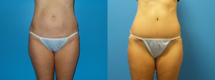 Before & After Tummy Tuck Case 421 View #2 View in Chicago, IL