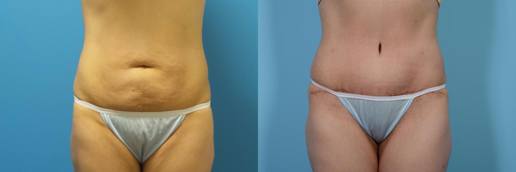Before & After Tummy Tuck Case 436 View #1 View in Chicago, IL