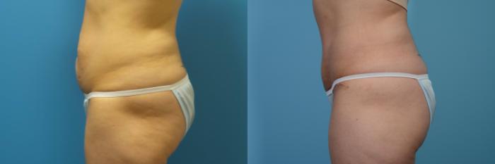 Before & After Tummy Tuck Case 436 View #3 View in Chicago, IL