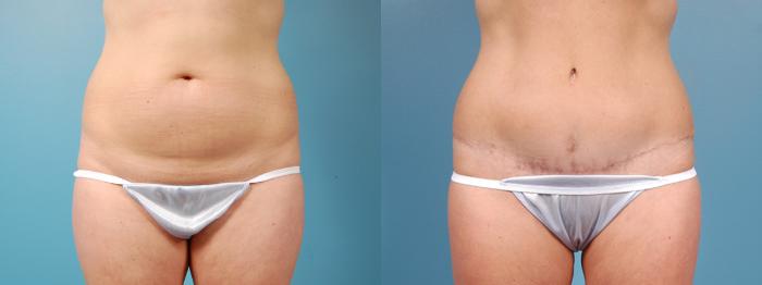 Before & After Tummy Tuck Case 5 View #1 View in Chicago, IL