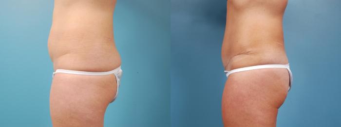Before & After Tummy Tuck Case 5 View #2 View in Chicago, IL
