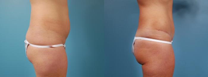 Before & After Tummy Tuck Case 5 View #3 View in Chicago, IL
