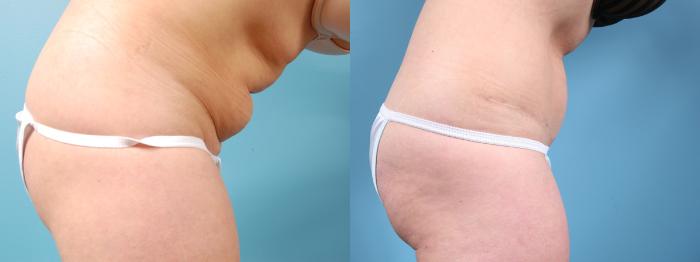 Before & After Tummy Tuck Case 5 View #4 View in Chicago, IL
