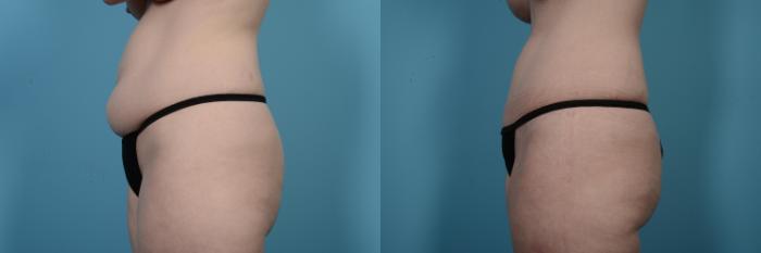 Before & After Tummy Tuck Case 504 View #2 View in Chicago, IL