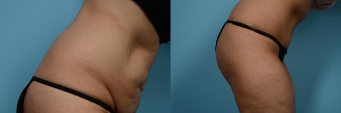 Before & After Tummy Tuck Case 519 View #4 View in Chicago, IL
