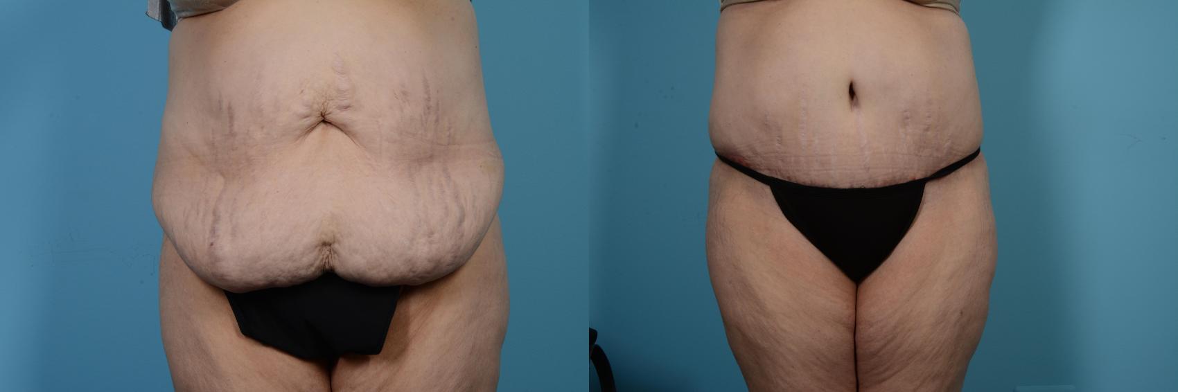 Before & After Tummy Tuck Case 524 View #1 View in Chicago, IL