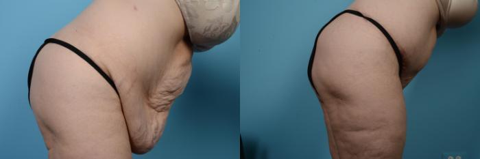 Before & After Tummy Tuck Case 524 View #4 View in Chicago, IL