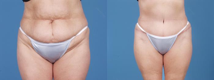 Before & After Tummy Tuck Case 54 View #1 View in Chicago, IL