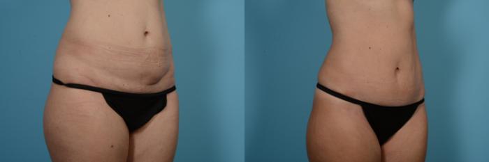 Before & After Tummy Tuck Case 550 Right Oblique View in Chicago, IL