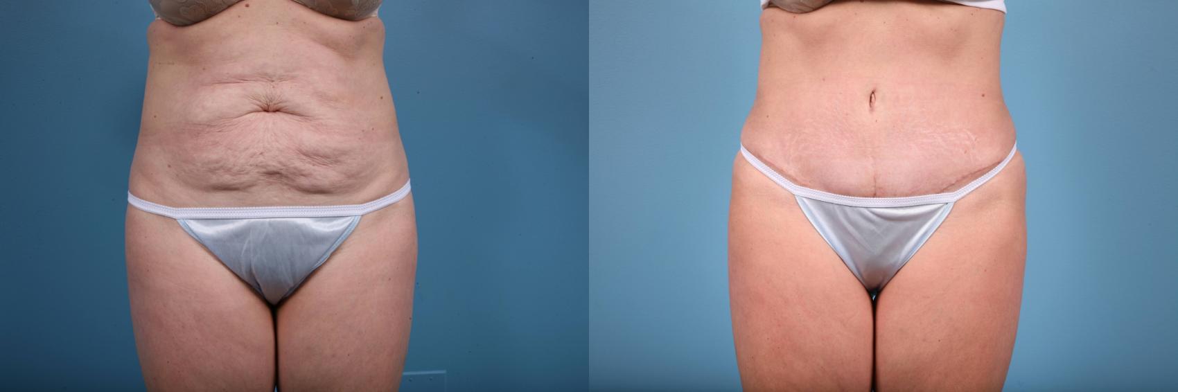 Before & After Tummy Tuck Case 64 View #1 View in Chicago, IL