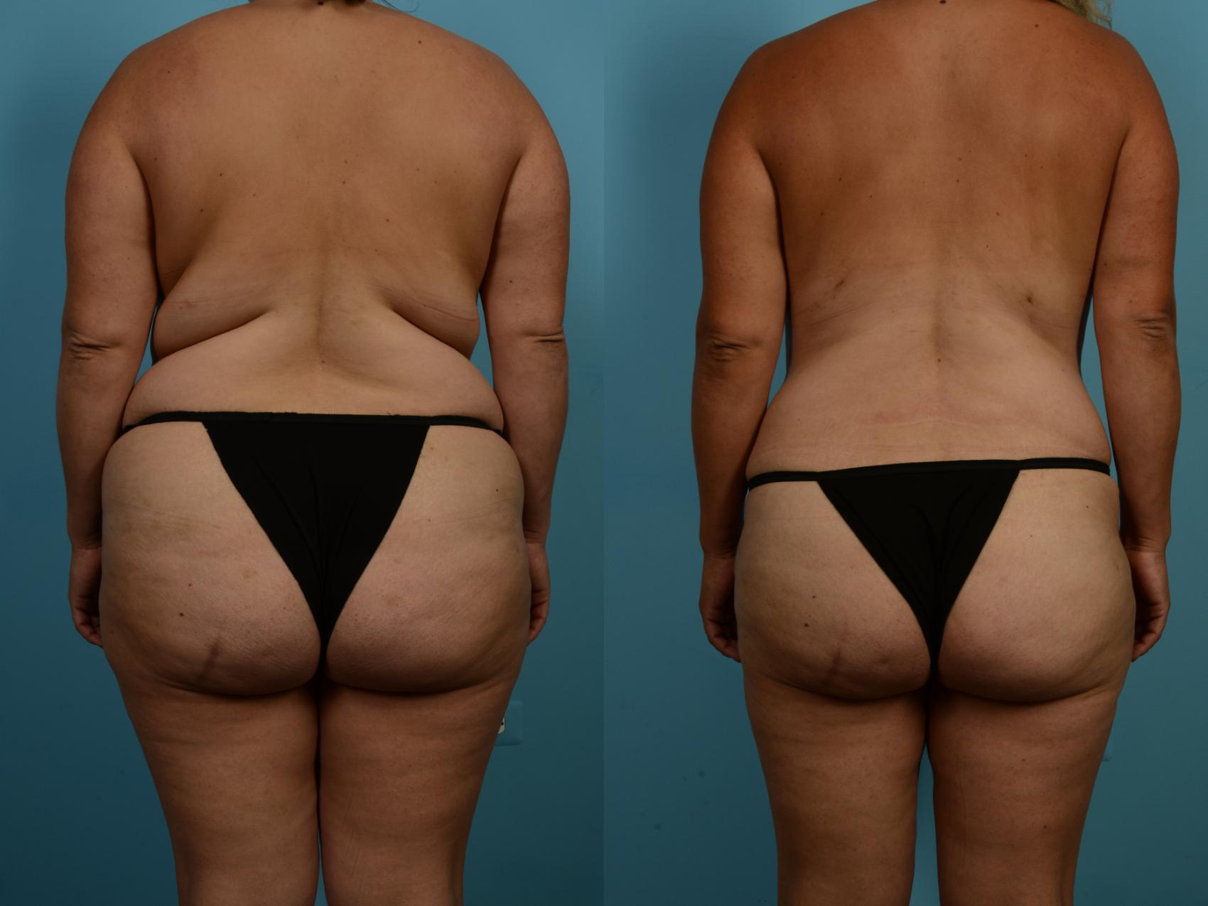 Dr. Sinno Abdominoplasty in Chicago, Illinois