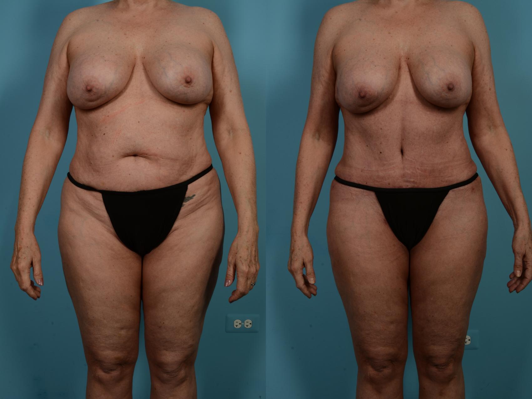 Dr. Sinno Abdominoplasty in Chicago, Illinois