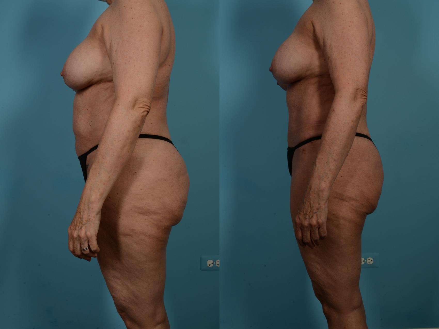 Dr. Sinno Abdominoplasty in Chicago, Illinois
