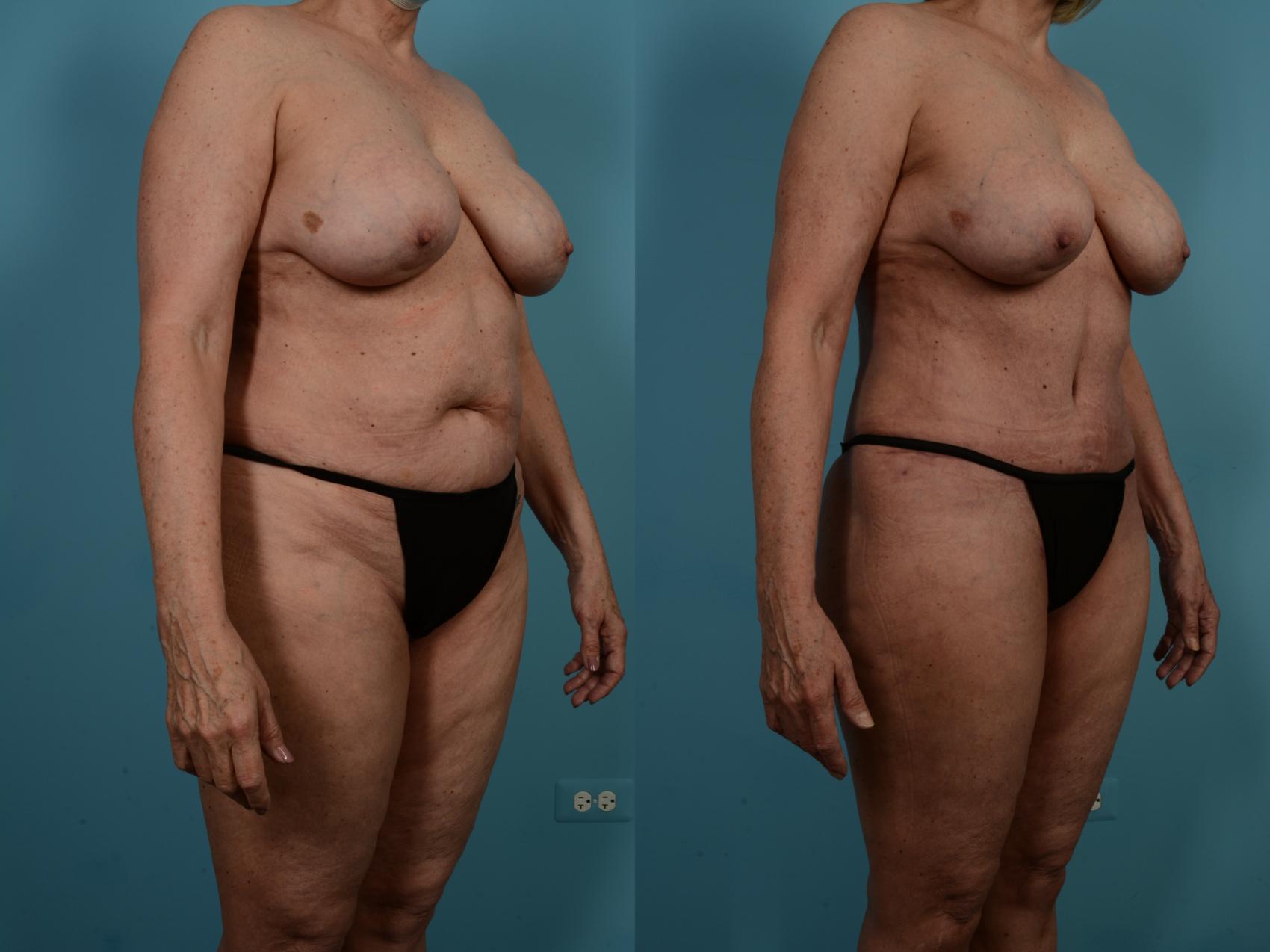 Dr. Sinno Abdominoplasty in Chicago, Illinois