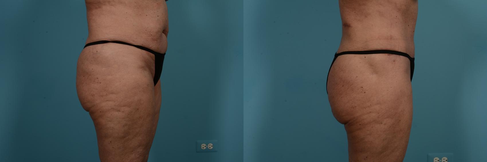 Dr. Sinno Abdominoplasty in Chicago, Illinois