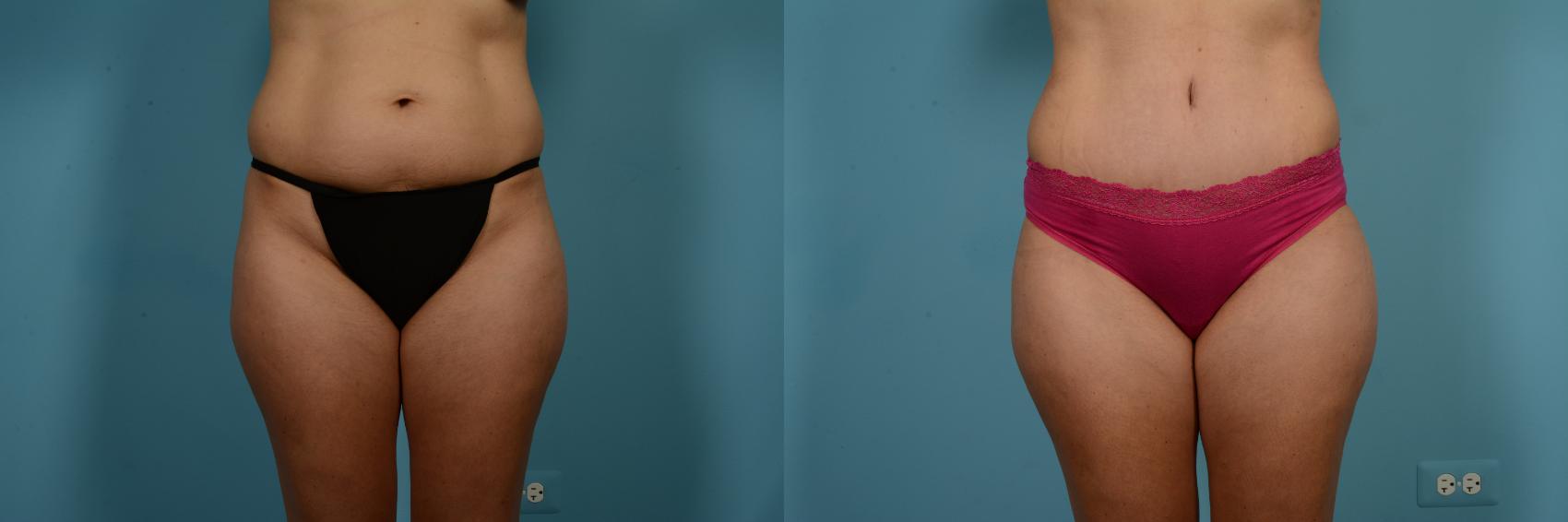 Dr. Sinno Abdominoplasty in Chicago, Illinois