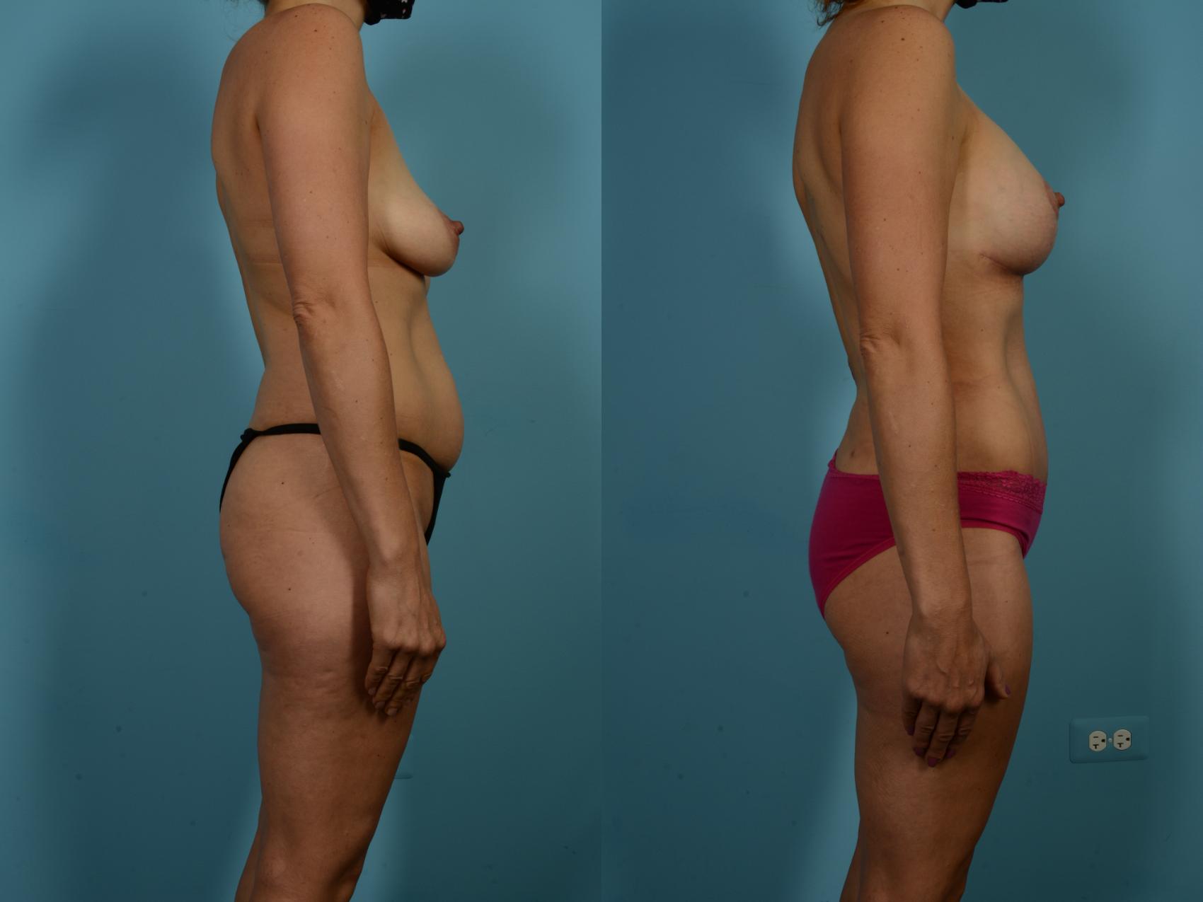 Dr. Sinno Abdominoplasty in Chicago, Illinois